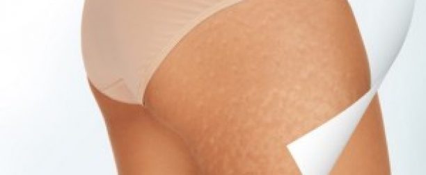 Cellulit – jak z nim walczyć?