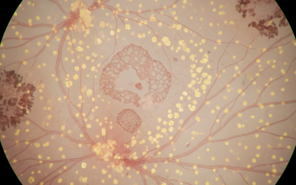 Autosomalna recesywna degeneracja siatkówki związana z RPE65